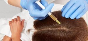 Saç Mezoterapisi Uygulaması Dilay Şahin Kozmetik